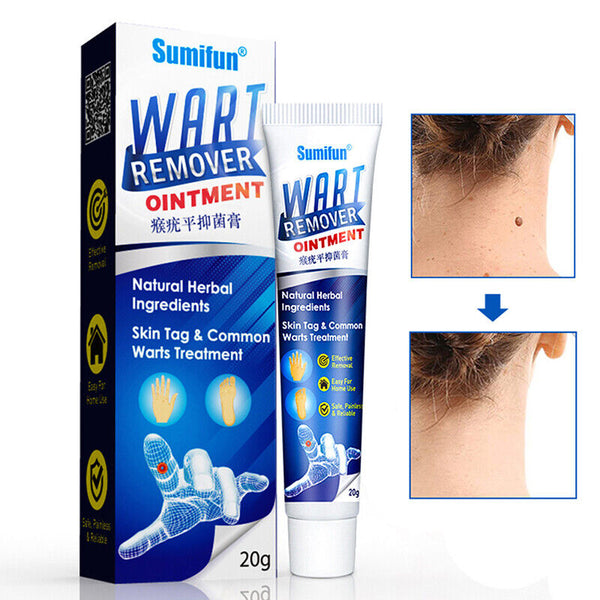 Wart removal cream